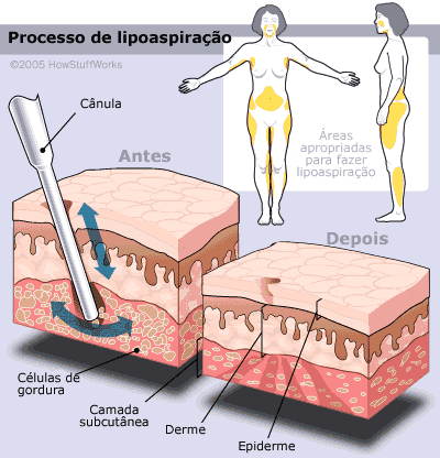 Lipoaspiração Abdominal (na Barriga) Feminina X Lipoescultura - Cirurgia  Plástica 