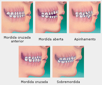 má oclusao