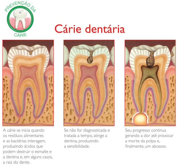 menos cárie