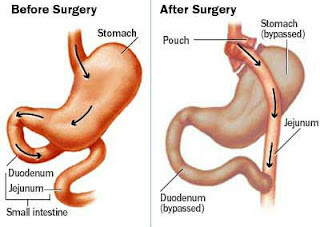 Como será realizada a cirurgia