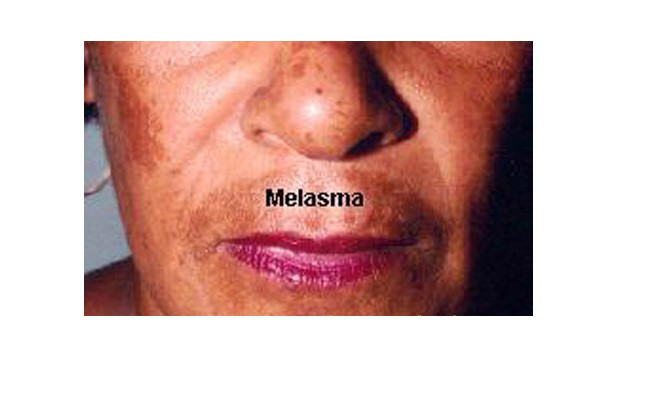 Melasma/ Cloasma