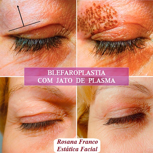 blefaroplastia