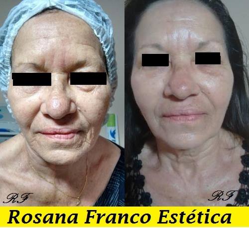 rejuvenescimento