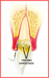 deposito de tartaro