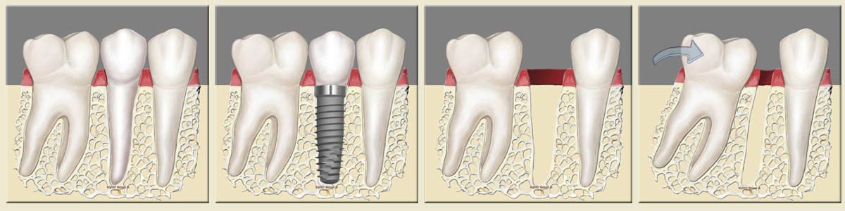 Quando um dente estiver ausente e não for substituido, os vizinhos irão migrar buscando o contato existente anteriormente