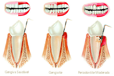 etapas de da doença periodontal