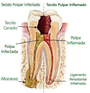 dente cariado