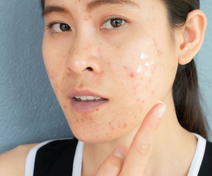 Foto de rosto de mulher cheio de acne