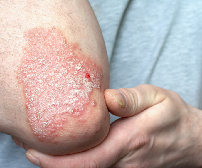 Foto de psor&iacute;ase no cotovelo