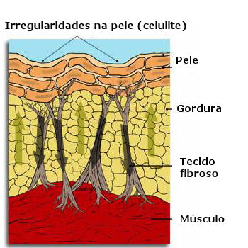 celulite/irregularidade na pele