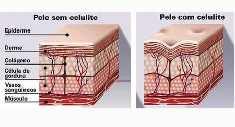 pele com celulite e sem celulite